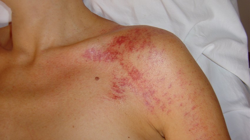 Gua sha ved muskelsmerter